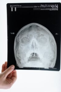 a person holding an x ray of the head